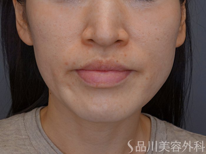 症例NO.74943のBEFORE写真