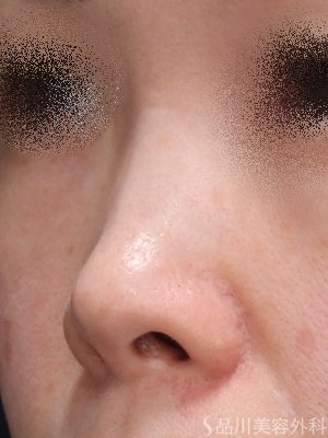 症例NO.74585のBEFORE写真