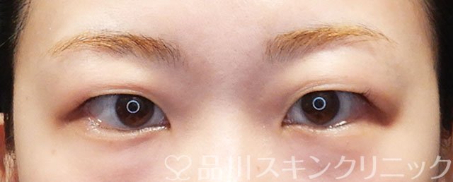 症例NO.75076のBEFORE写真