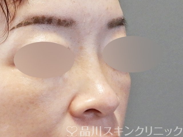 症例NO.66774のBEFORE写真