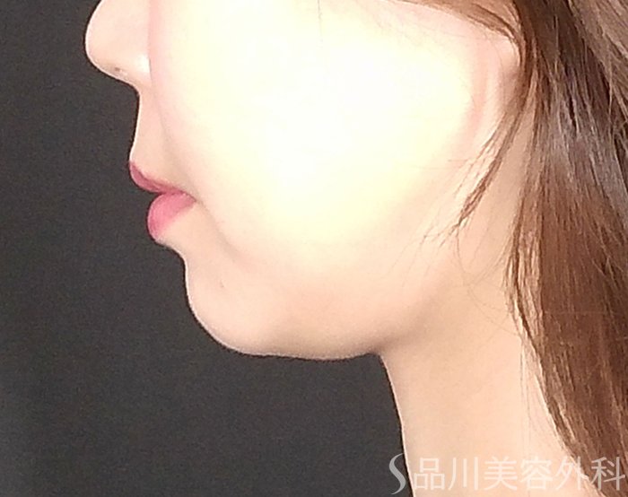 症例NO.69534のBEFORE写真