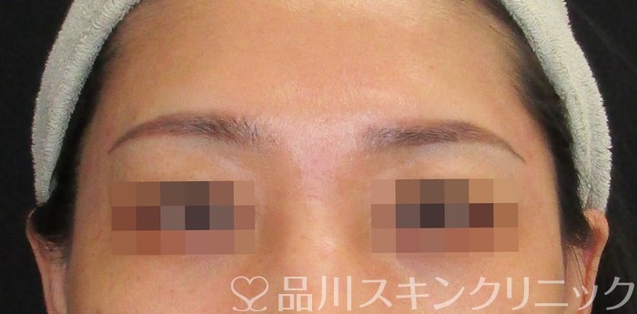 症例NO.74840のAFTER写真