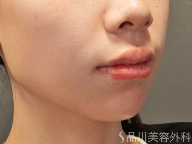 症例NO.72718のAFTER写真