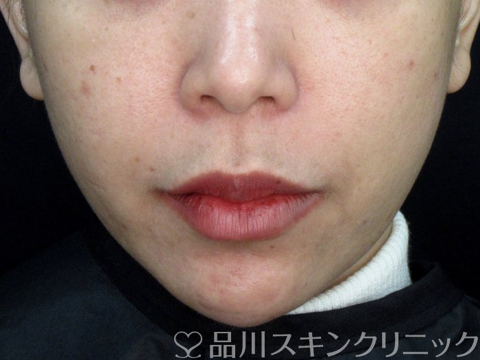 症例NO.73806のAFTER写真
