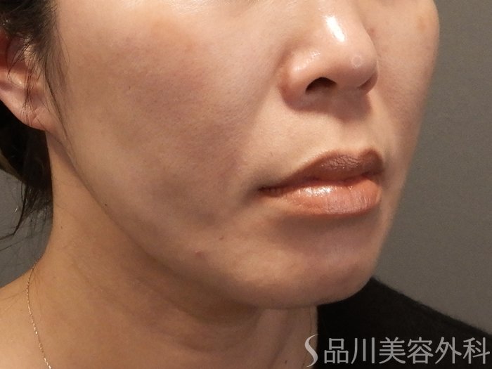 症例NO.69598のAFTER写真