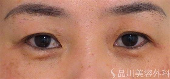 症例NO.47404のBEFORE写真