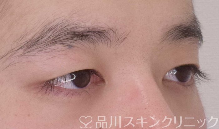 症例NO.64807のBEFORE写真