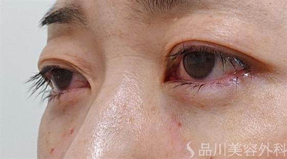 症例NO.54274のAFTER写真