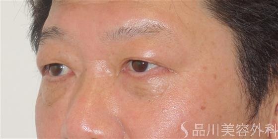 症例NO.43539のAFTER写真