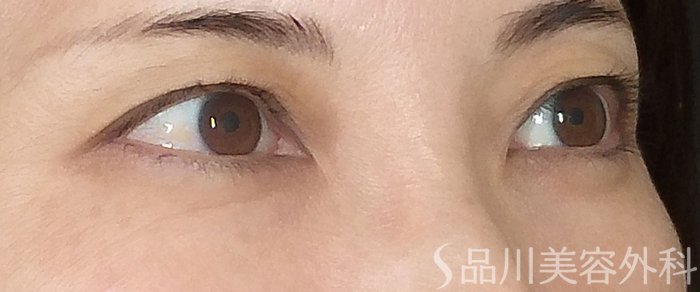 症例NO.73078のBEFORE写真