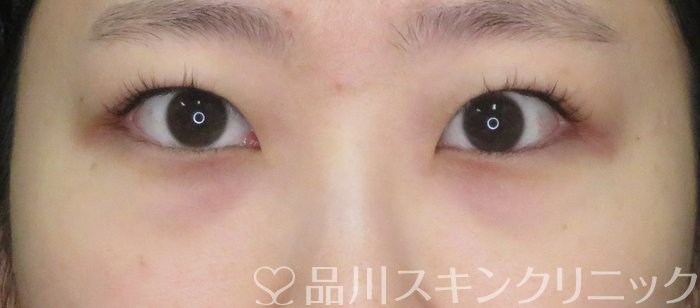 症例NO.74860のBEFORE写真