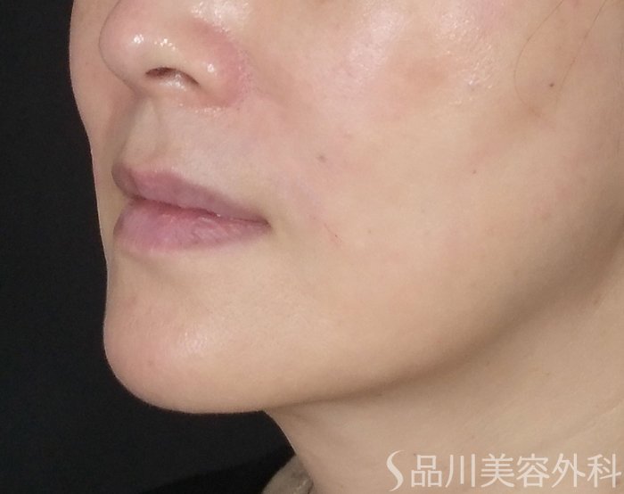 症例NO.70450のAFTER写真