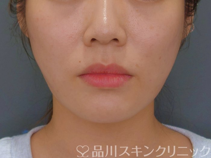 症例NO.73802のAFTER写真