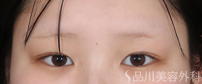 症例NO.73448のBEFORE写真