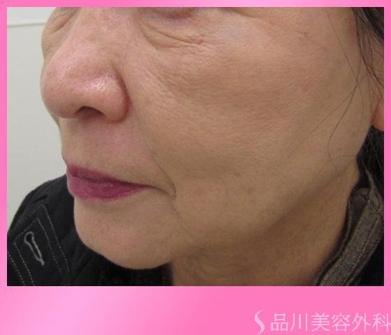 症例NO.2858のAFTER写真