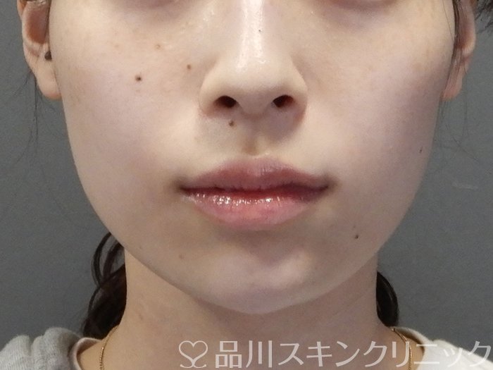 症例NO.70601のAFTER写真