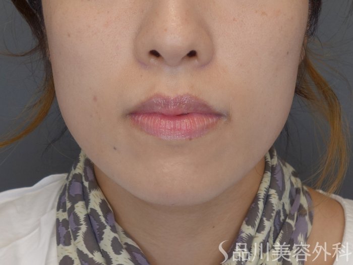 症例NO.71773のAFTER写真