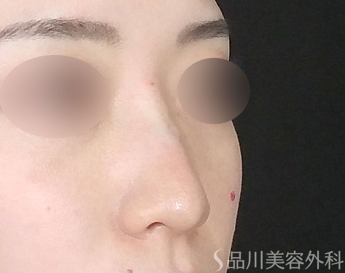 症例NO.72115のAFTER写真