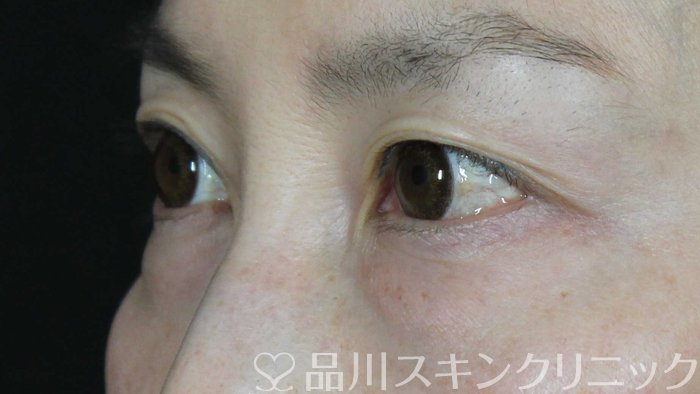 症例NO.69757のBEFORE写真