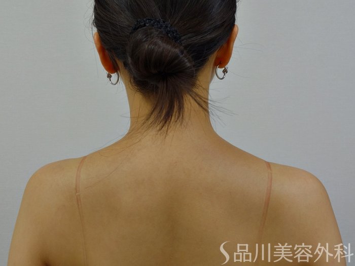 症例NO.73363のBEFORE写真