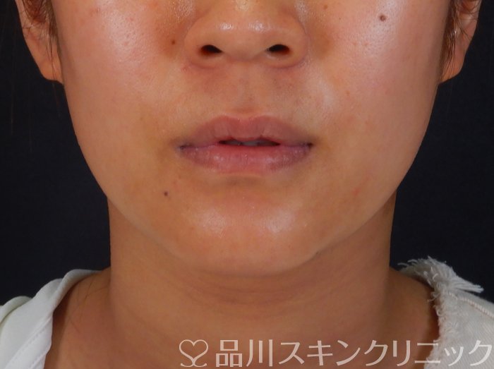 症例NO.65842のBEFORE写真