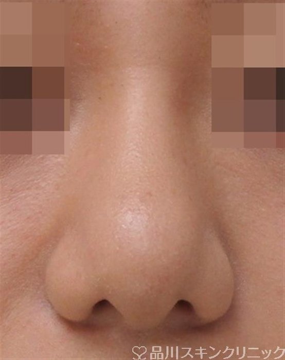症例NO.40662のAFTER写真