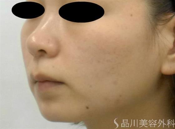 症例NO.40811のBEFORE写真