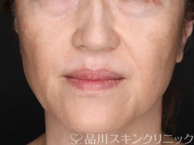 症例NO.71628のBEFORE写真