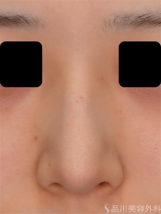 症例NO.51739のBEFORE写真