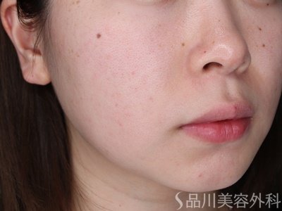 症例NO.71487のAFTER写真