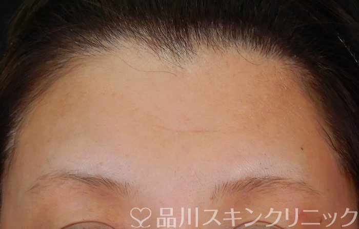 症例NO.66590のBEFORE写真
