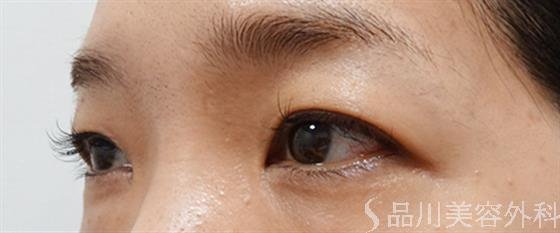 症例NO.52516のBEFORE写真