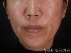 症例NO.74306のBEFORE写真