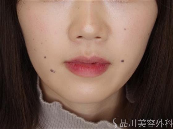 症例NO.49712のBEFORE写真