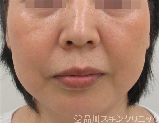 症例NO.27602のBEFORE写真