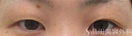 症例NO.24187のBEFORE写真