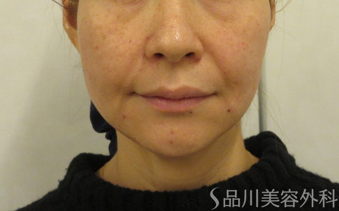 症例NO.72214のAFTER写真