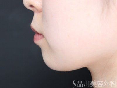 症例NO.69636のBEFORE写真