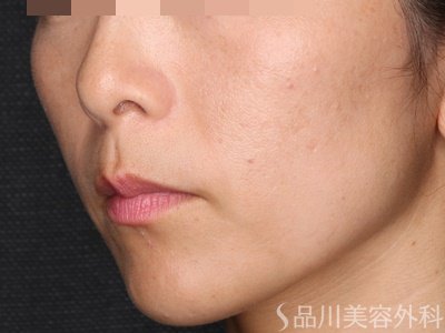 症例NO.72482のBEFORE写真