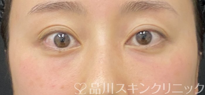 症例NO.74931のAFTER写真