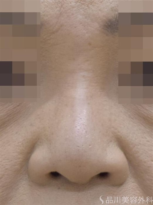 症例NO.51563のBEFORE写真