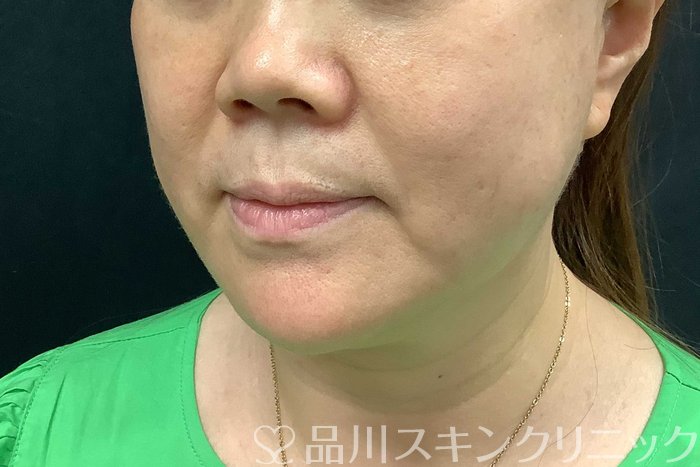 症例NO.71283のBEFORE写真