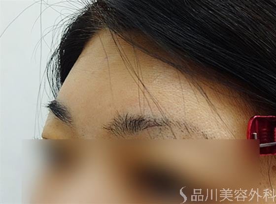 症例NO.36143のAFTER写真