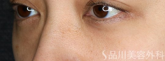 症例NO.73332のBEFORE写真