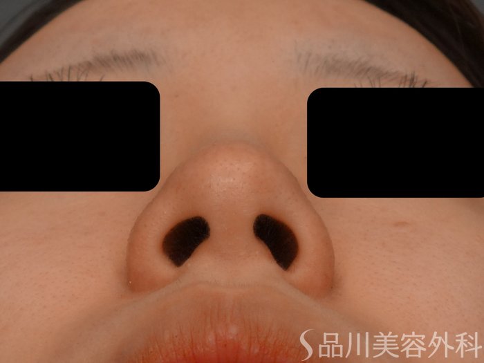 症例NO.73734のBEFORE写真