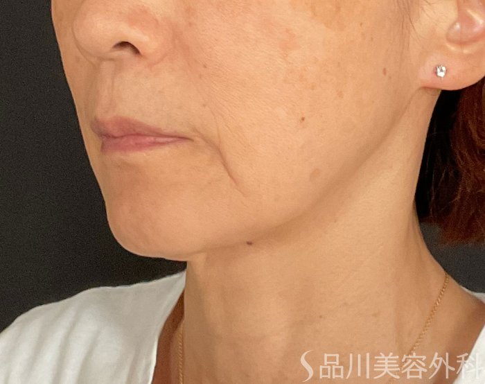 症例NO.74523のBEFORE写真