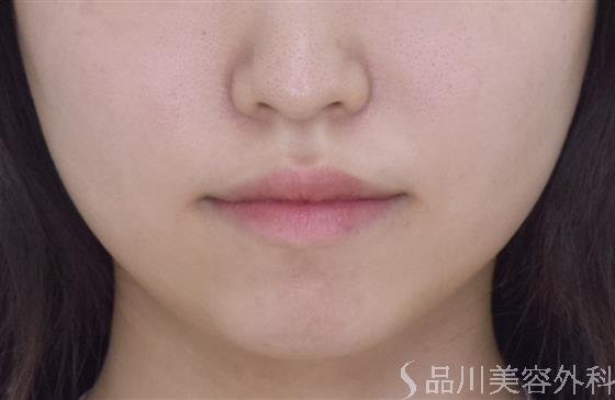 症例NO.50066のBEFORE写真