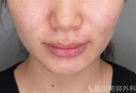 症例NO.47330のBEFORE写真