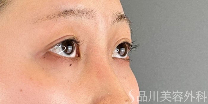 症例NO.69718のBEFORE写真