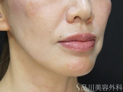 症例NO.75067のAFTER写真